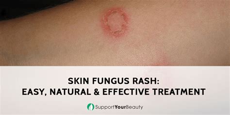 Skin Fungus Rash Easy Natural And Effective Treatment