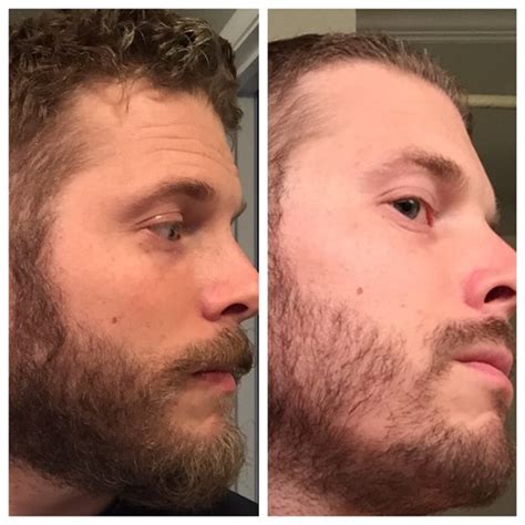 Patchy Beard Success Stories Before And After Photos Page 10 Beard