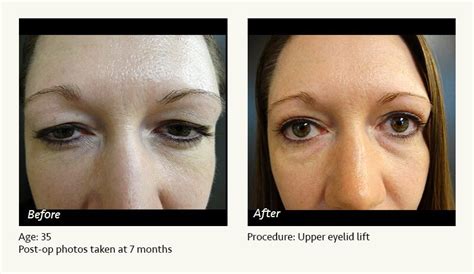 Eye Lift Procedure Cheaper Than Retail Price Buy Clothing Accessories And Lifestyle Products