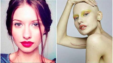 Elizaveta Bulokhova La Modelo Que Venció El Cáncer De Mandíbula