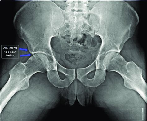 anteroposterior pelvic radiograph demonstrating excessive pelvic tilt download scientific