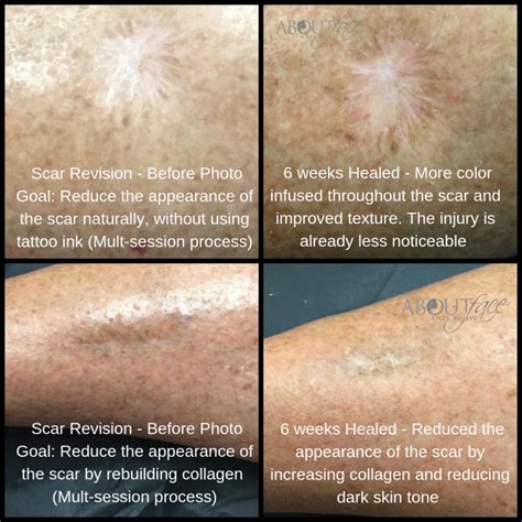 Stretch Mark And Scar Revision Results • About Face And Body