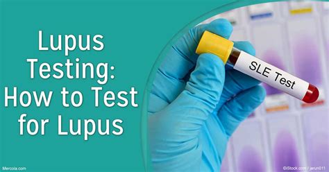 Lupus Testing How To Test For Lupus