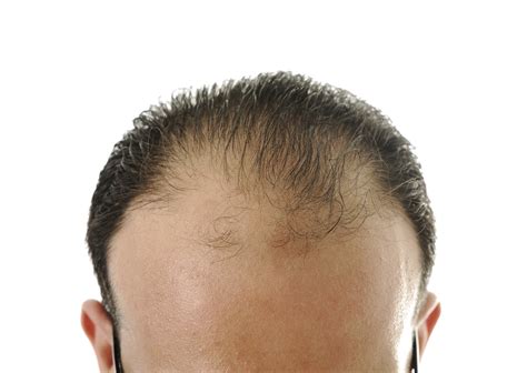 Hair Toppiks Why Is My Hair Thinning Thinning Hair In Your 20s And 30s
