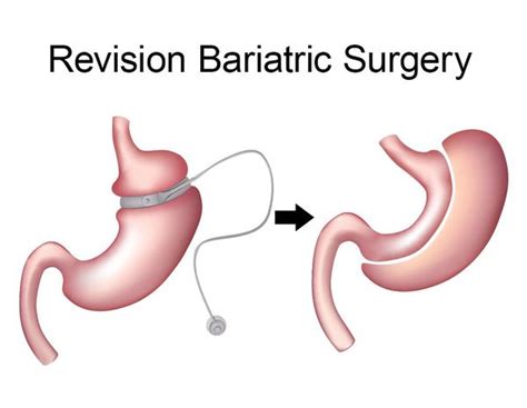 Revision Bariatric Surgery Texas Advanced Surgical And Bariatrics