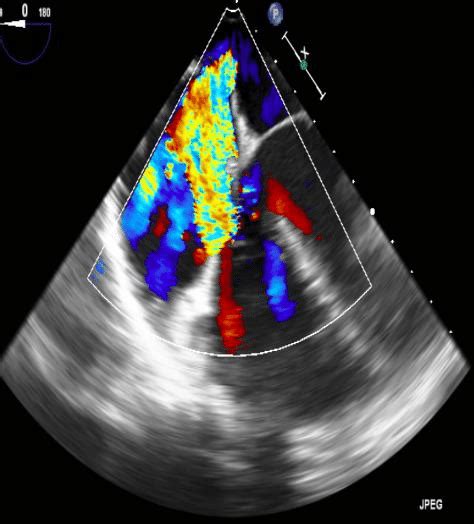 Transesophageal Echocardiogram Demonstrating Severe Tricuspid
