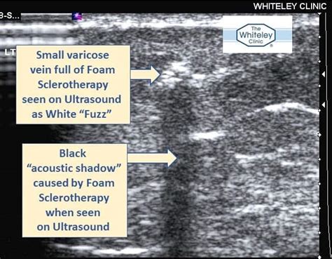 Ultrasound Guided Foam Sclerotherapy Treatment The Whiteley Clinic