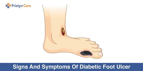 Signs And Symptoms Of Diabetic Foot Ulcer Pristyn Care