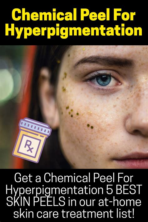 Topical Creams Chemical Peels And Laser Therapy For Hyperpigmentation