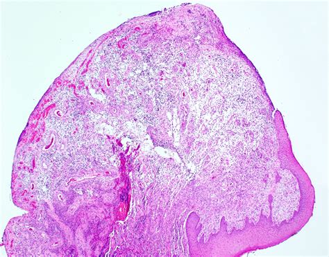 Pyogenic Granuloma Lips Pathology Outlines