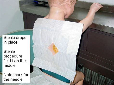 Clinical Notes Thoracentesis A Step By Step Procedure Guide With Photos