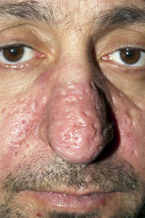 Rhinophyma Of The Nose Stock Image C0070667 Science Photo Library