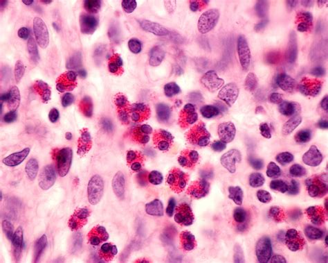 High Blood Eosinophil Count Linked To Asthma Related Hospital Readmission