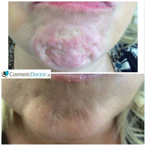 Botox For Chin Dimples Cosmetic Doctor Dublin Cosmetic Doctor Dublin