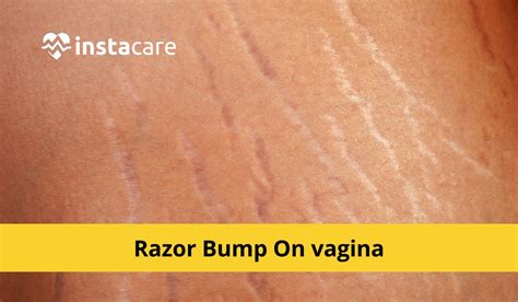 How To Quickly Get Rid Of Razor Bumps On The Vagina