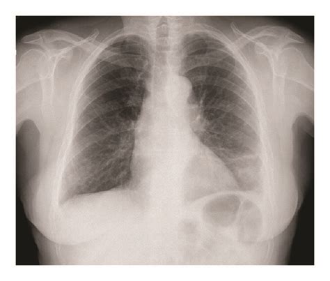 Posteroanterior A And Lateral B Chest X Rays The Chest Radiography