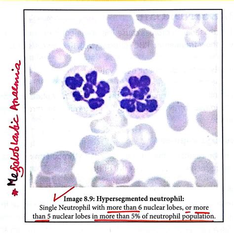 Hypersegmented Neutrophils Megaloblastic Anaemia Note