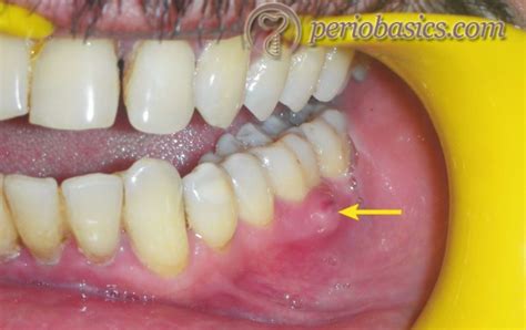 Periodontal Abscess And Its Treatment