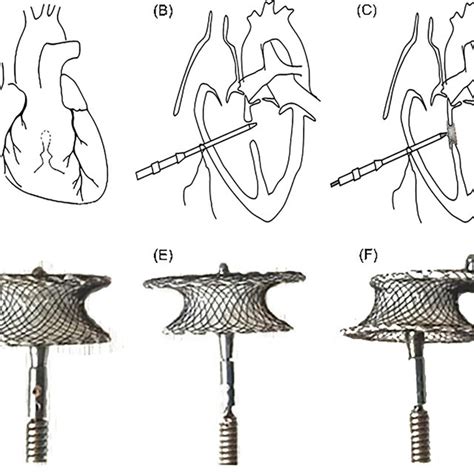 Schematic Illustrating The Perventricular Device Closure Of Vsd And The