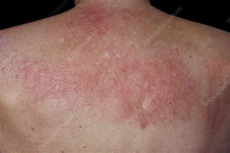Heliotrope Rash In Dermatomyositis Stock Image C0542550 Science