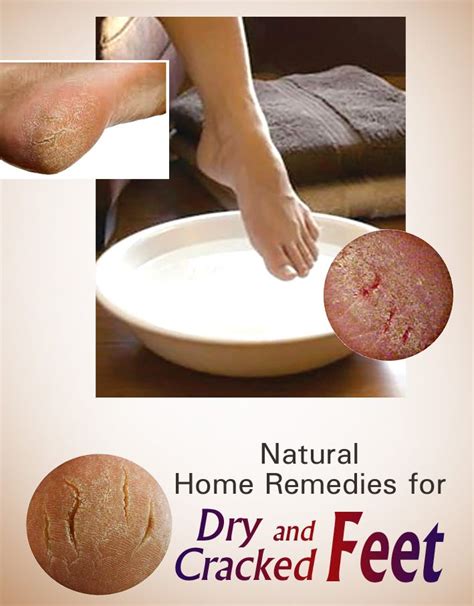 Natural Home Remedies For Dry And Cracked Feet Natural Home Remedies Home Remedies Remedies