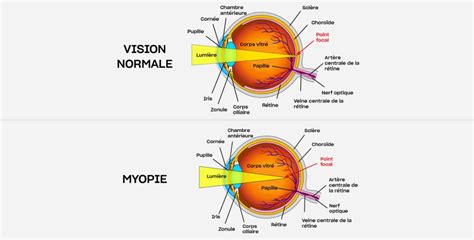 Myopie Diagnostic Et Traitement Paris Au Centre Ophtalmologique Coss