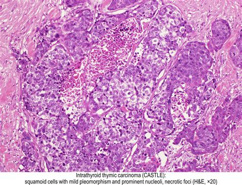 Pathology Outlines Thymoma Thymic Carcinoma