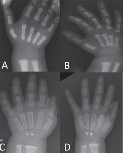 Time Of Appearance Of Ossification Centers In Carpal Bones Saudi