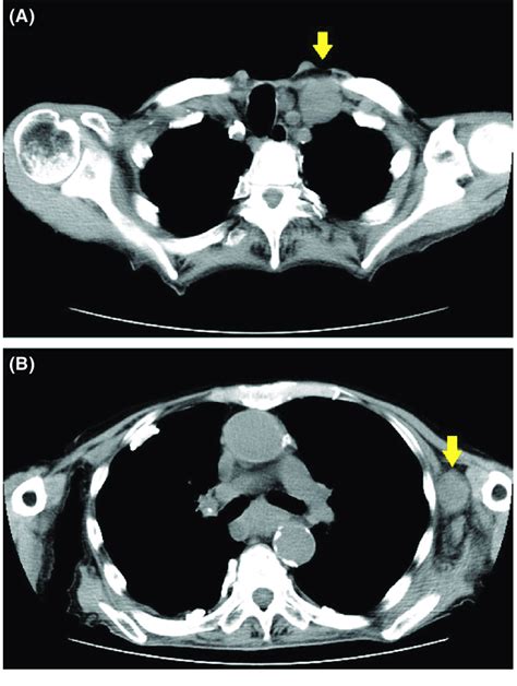Ct Imaging Revealed A Left Supraclavicular Lymph Node Metastasis A