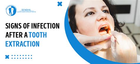 Signs Of Infection After A Tooth Extraction