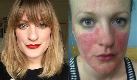 Letstalkaboutit Rosacea The Little Known Redness Causing Skin