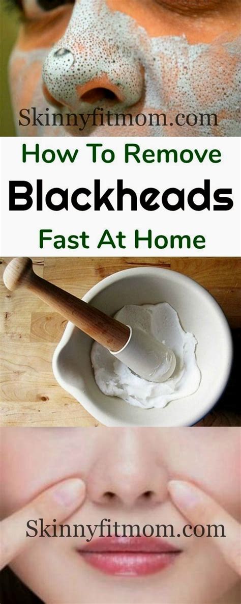 Remove Blackheads With One Simple And Effective Trick In 2020 Natural Home Remedies