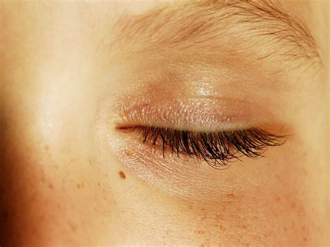 How Does Herpes Zoster Affect The Eyes