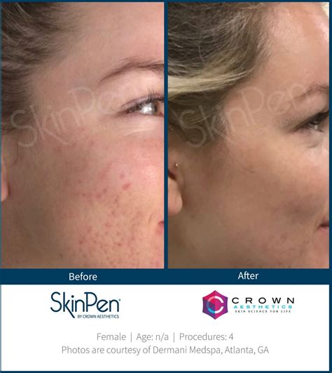Skinpen Before And After Skinpen Microneedling Crown Aesthetics