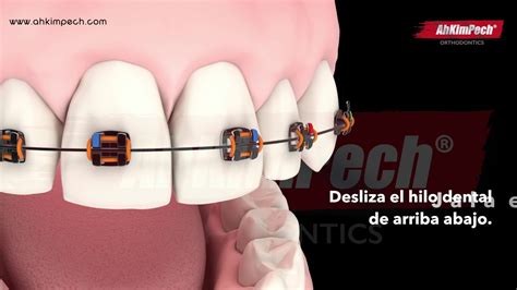 Utilizar El Hilo Dental De Manera Correcta Con Brackets Youtube