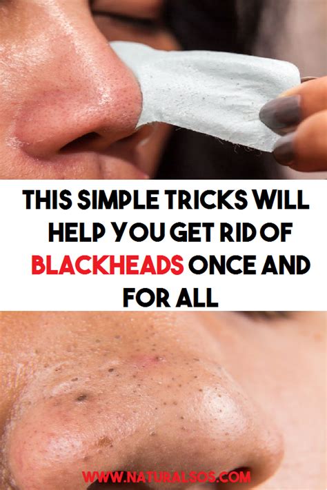 This Simple Tricks Will Help You Get Rid Of Blackheads Once And For All