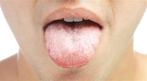 Молочница лечение диета Молочница у мужчин: симптомы, фото и схема лечения Молочница у мужчин: симптомы, фото и схема лечения Молочница лечение диета