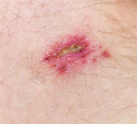 Wound Infection Stock Photos Pictures And Royalty Free Images Istock