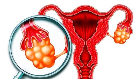 Quistes En Los Ovarios Causas S Ntomas Y Tratamiento