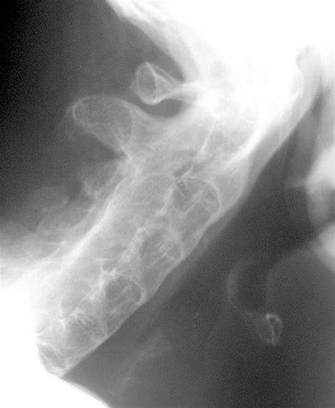 Ankylosing Spondylitis Of The Cervical Spine Image