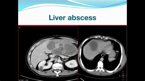 Liver Abscess YouTube