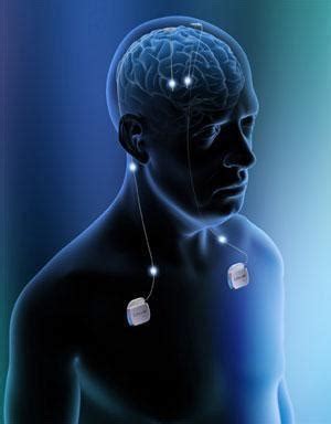 Deep Brain Stimulation Dbs Pomona Ca Arcadia Ca Inland