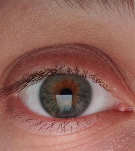 Whats The Difference Between Central Heterochromia And Hazel Eyes