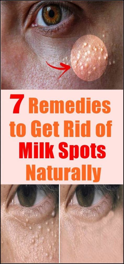 7 Remedies To Get Rid Of Milk Spots Naturally Holistic Life Route