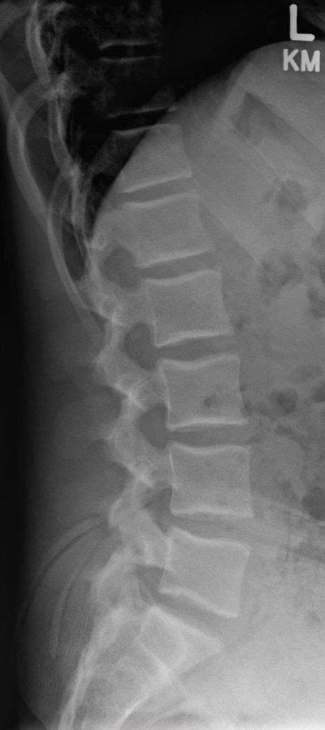 Normal Lateral Lumbar Spine Radiograph Radiology Case Radiopaedia