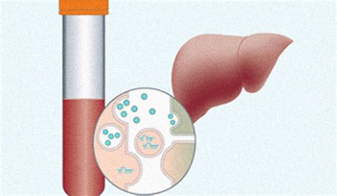 prueba in vitro para diagnóstico temprano y estatificación de fibrosis hepática enlace unam