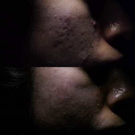 Hypertrophic Scars Treatment Before And After Scar Healing Institute