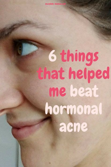 Hormonal Acne Is Hard To Get Rid Of But Its Not Impossible After