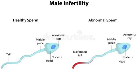 Male Infertility Stock Vector Illustration Of Fertilisation 41897994