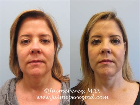 52 Year Old Woman New Look Facelift Before And After Gallery